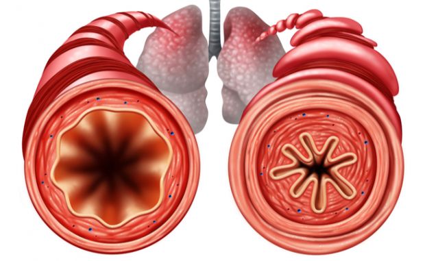 Asma, nuove raccomandazioni per il trattamento